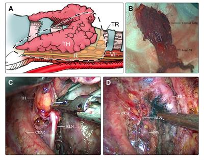 Feasibility and safety of modified en-bloc resection in endoscopic thyroid surgery via bilateral areolar approach – long-term institutional analysis ten years after surgery